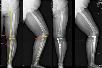 High tibial lateral closing wedge and opening wedge valgus osteotomy produce different effects on posterior tibial slope and patellar height